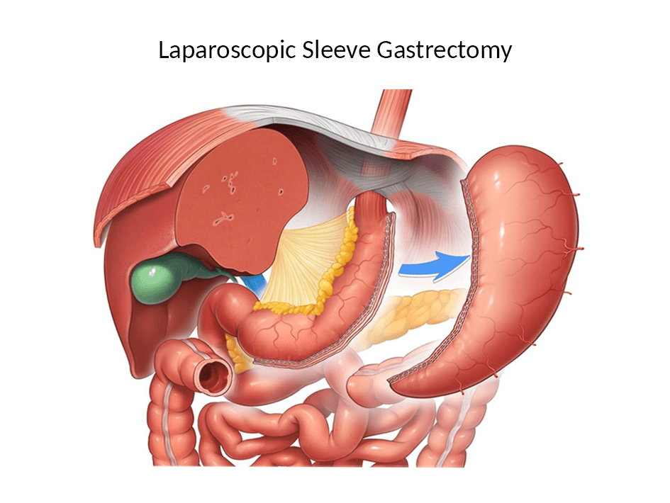 Laparoscopic-sleeve-Gastrectomy